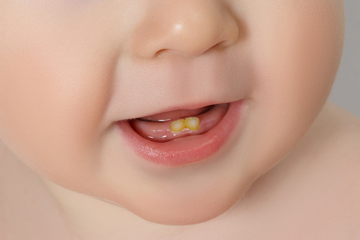 bebeklerde diş sararması neden olur
