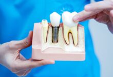 implant