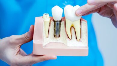 implant
