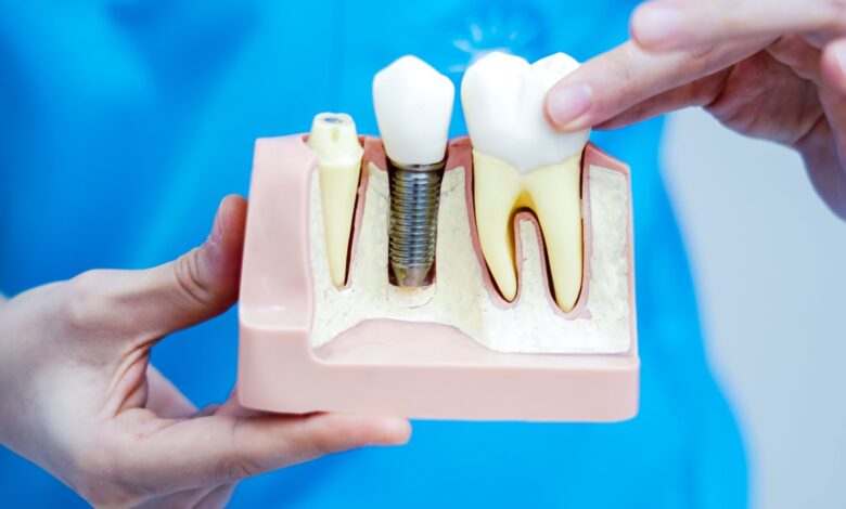 implant
